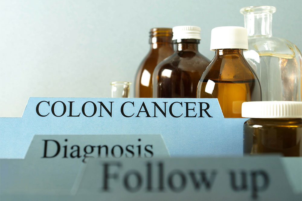 Colon cancer &#8211; Causes, symptoms, and treatments