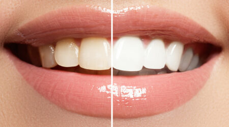 Things to know about teeth whitening