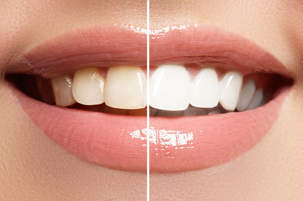 Things to know about teeth whitening