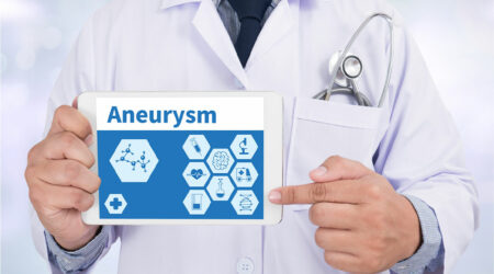 Aneurysm &#8211; Types, symptoms, and other important information