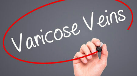 Varicose veins &#8211; Causes, risks, and treatments explained