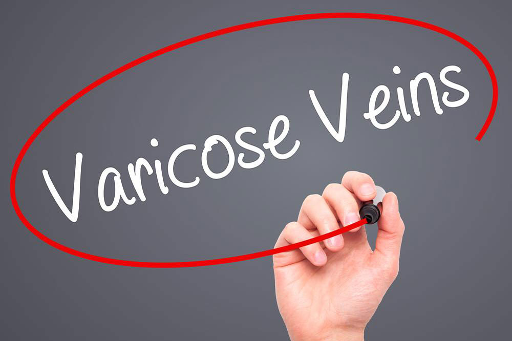 Varicose veins &#8211; Causes, risks, and treatments explained