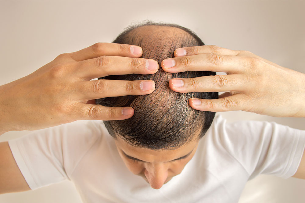 Alopecia areata &#8211; causes, symptoms, diagnosis, and home remedies