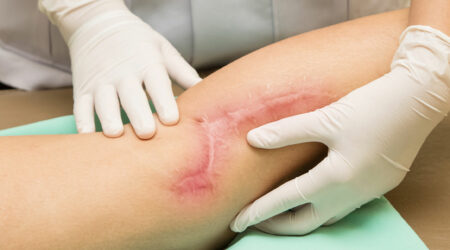 Scar tissue &#8211; Its causes and ways to manage it