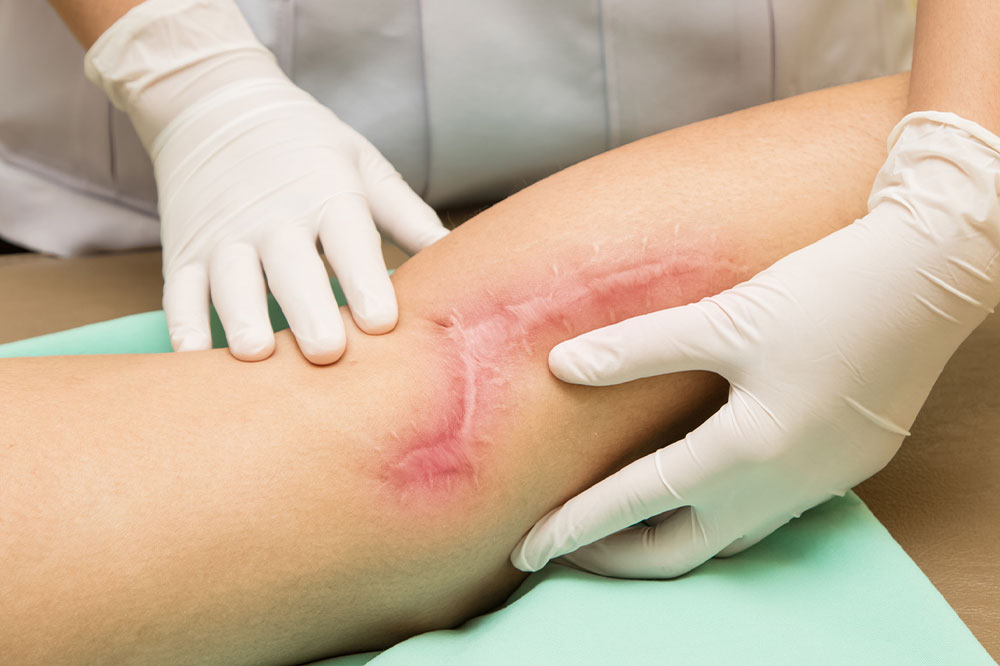 Scar tissue &#8211; Its causes and ways to manage it