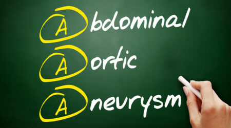 What is an abdominal aortic aneurysm