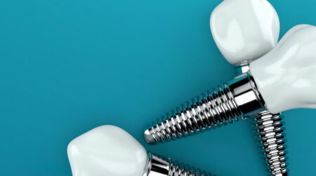 All you need to know about dental implants