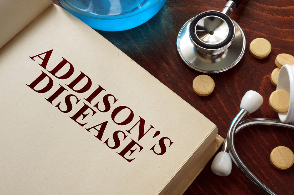 A comprehensive guide to Addison disease