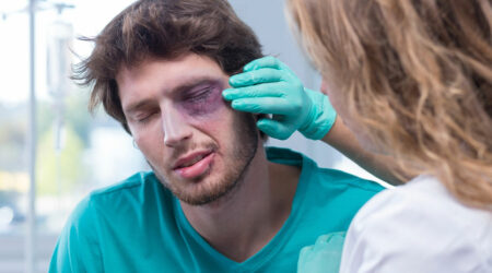 Black eye &#8211; Symptoms, causes, and management