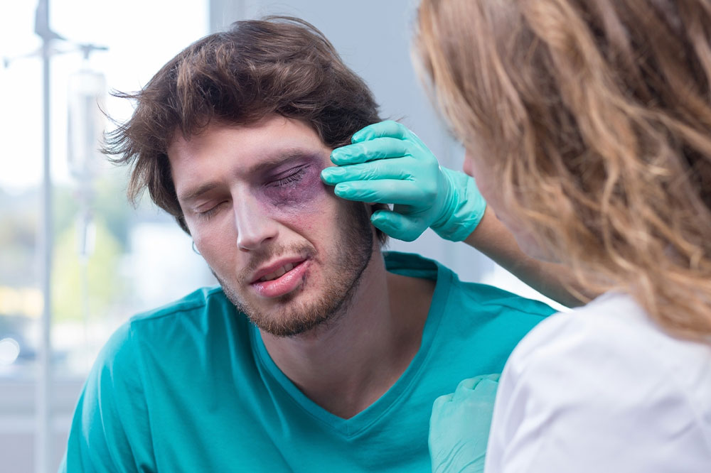 Black eye &#8211; Symptoms, causes, and management