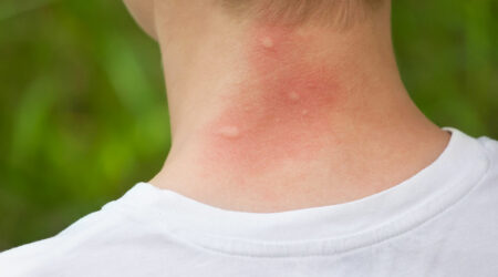 Mosquito bites &#8211; Symptoms, remedies, and management