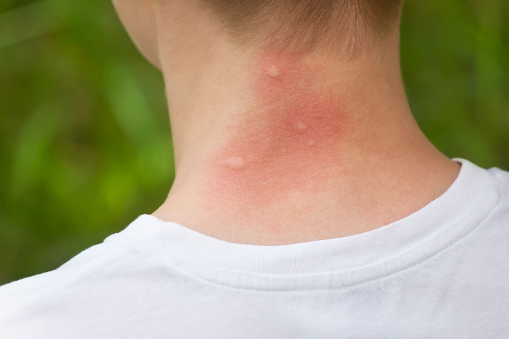 Mosquito bites &#8211; Symptoms, remedies, and management