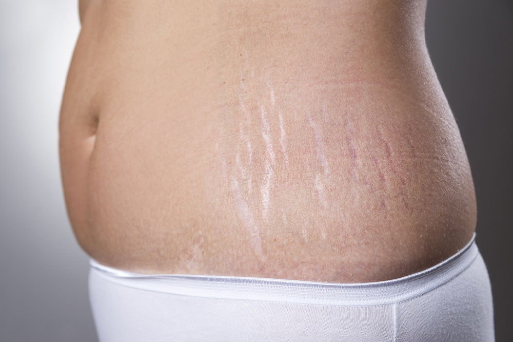 Stretch marks &#8211; Management and prevention