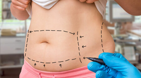 Types of liposuction surgery, their costs, and more