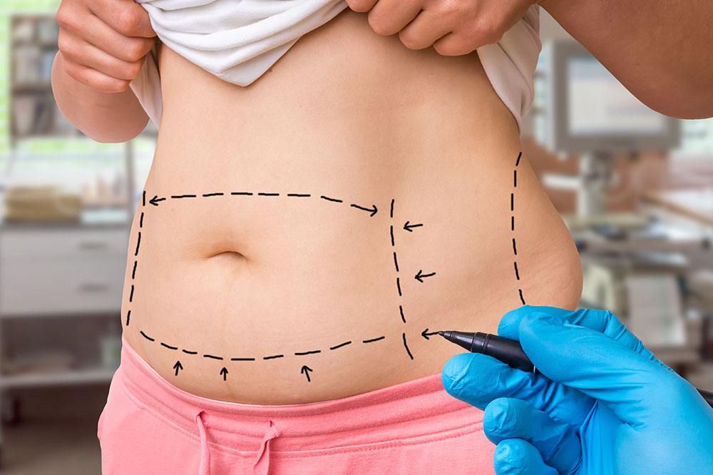 Types of liposuction surgery, their costs, and more