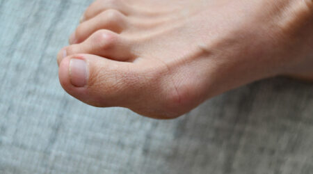 Bunion surgery &#8211; Types, cost, and more