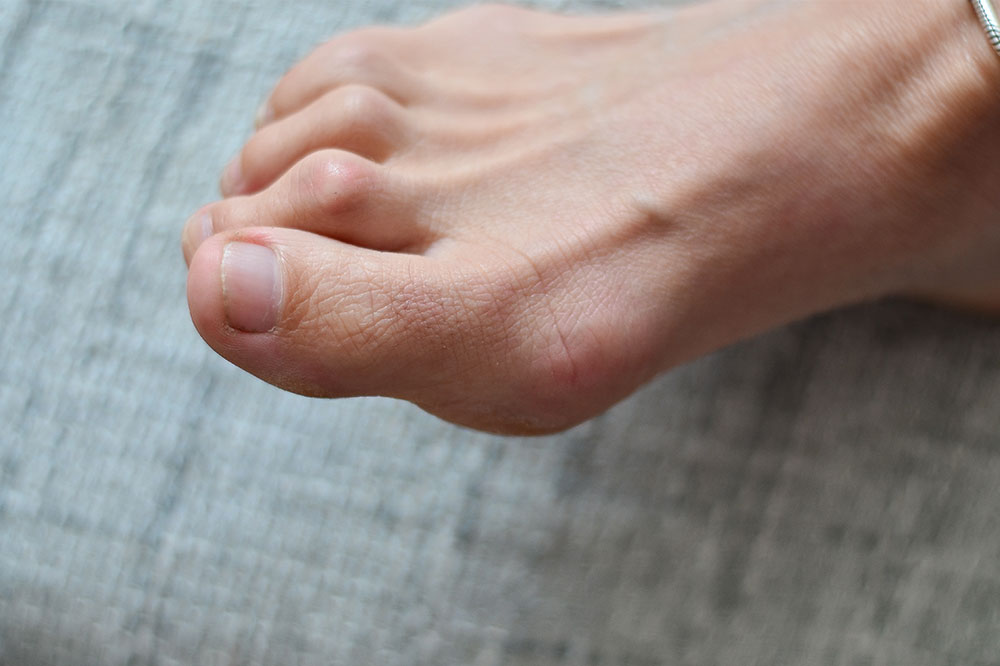 Bunion surgery &#8211; Types, cost, and more