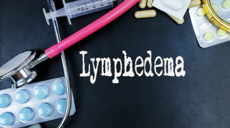 Lymphedema &#8211; Causes, signs, and management