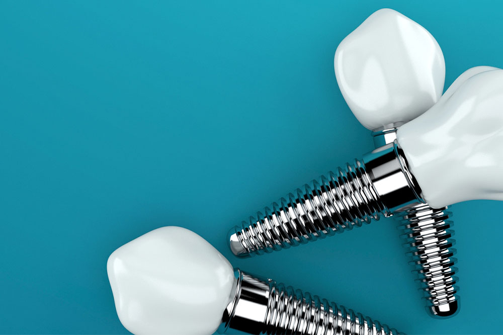 All you need to know about dental implants