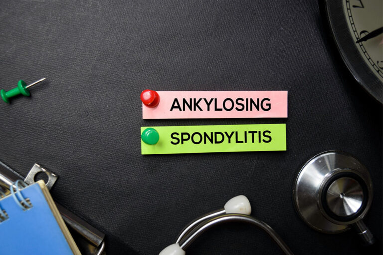 Ankylosing spondylitis – Causes, symptoms, and management options