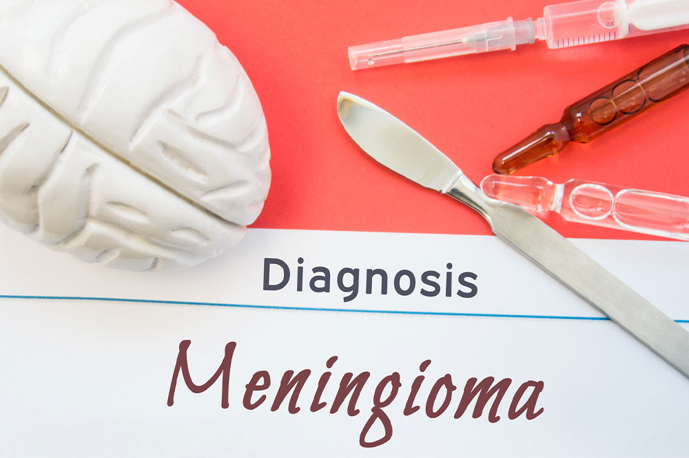 Meningioma &#8211; Signs, causes, and management